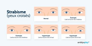 strabisme_yeux_croises strabisme_yeux_croises